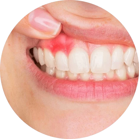 Баннер Лечение пародонтита Баннер Лечение пародонтита